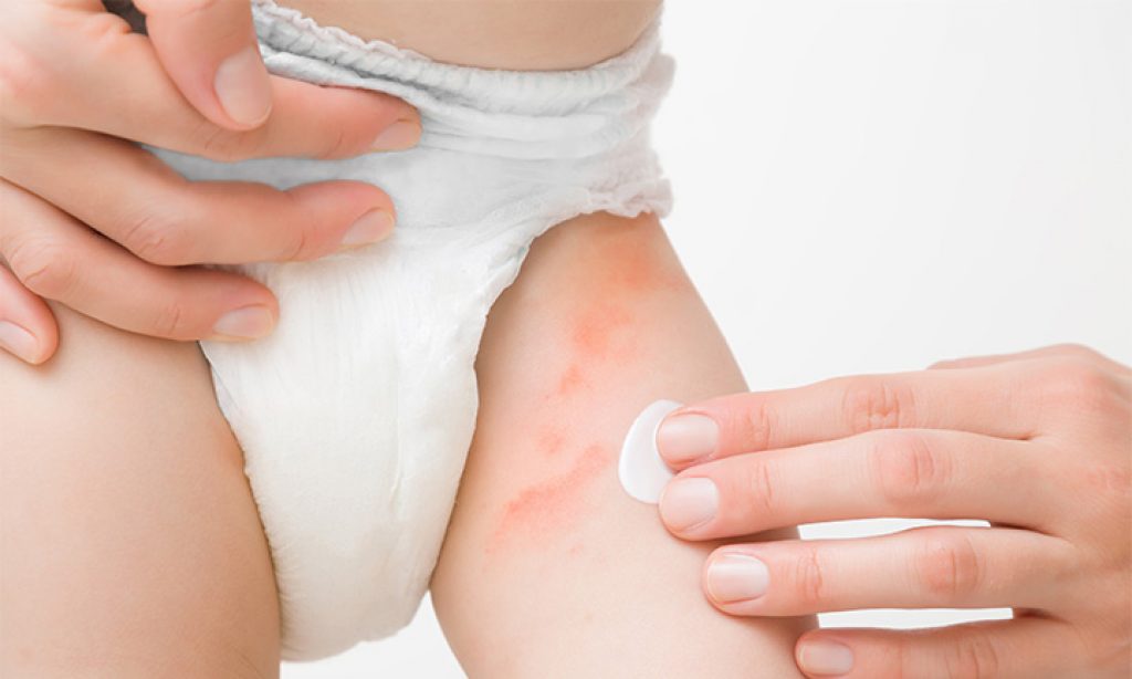 Best Diaper rash creams have anti-fungal agents.